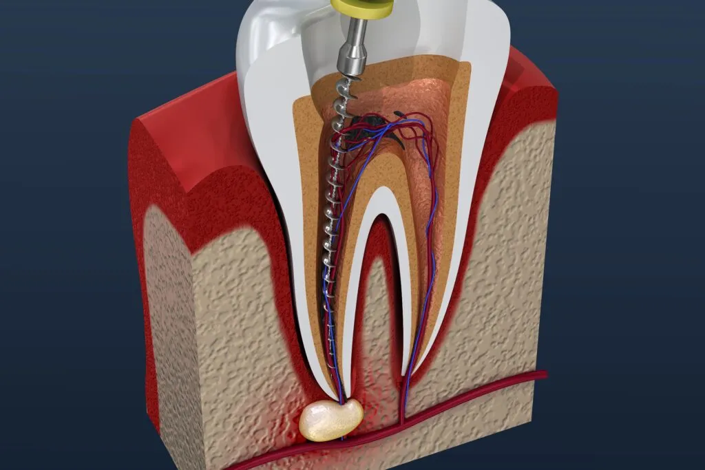 Is Root Canal Treatment Effective for Dental Abscess?