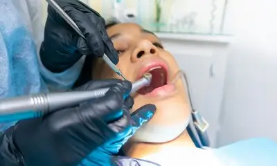 Cavity Fillings Look Like