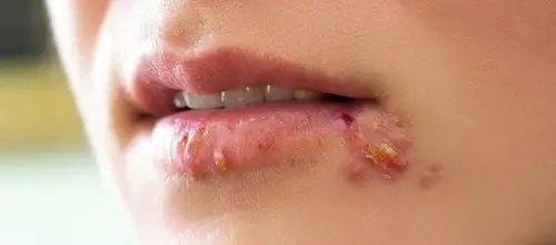 How Are Cold Sores Spread?