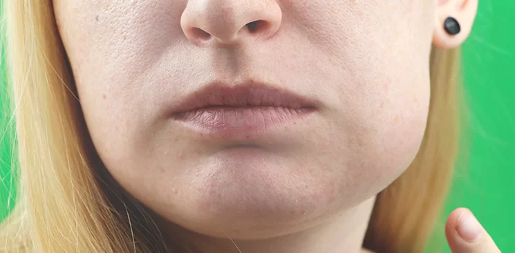 Facial Swelling and Dental Infection: When It Becomes a Dental Emergency Facial Swelling and Dental Infection